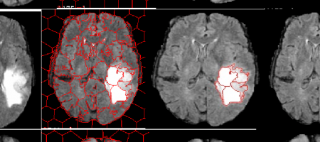 Paper Publication [Brain Tumor Segmentation using SLIC Superpixels and Optimized Thresholding Algorithm] from CoDe Lab